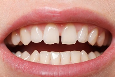 Teeth have gap